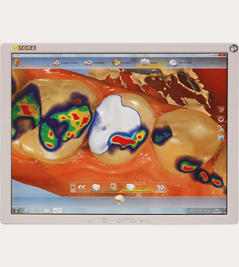 Symbolbild: Cerec-Planung einer Keramikversorgung am Bildschirm